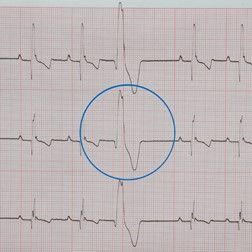 ekg