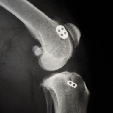 Orthopädische, Knochen-, Gelenks-Chirurgie