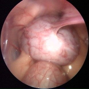 blasensteinoperationen