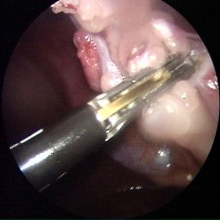 endoskopische kastration